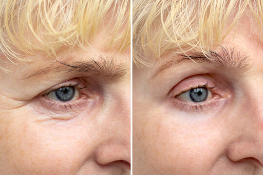 Blefaroplastia preço