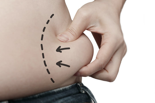 Lipo abdominoplastia